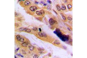 Immunohistochemical analysis of JNK2 staining in human lung cancer formalin fixed paraffin embedded tissue section. (JNK2 Antikörper  (Center))