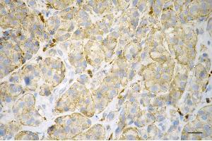 Immunohistochemistry was performed on paraffin-embedded human melanoma using ITGB1BP1 antibody (ABIN7799068), 1:200). (ITGB1BP1 Antikörper)