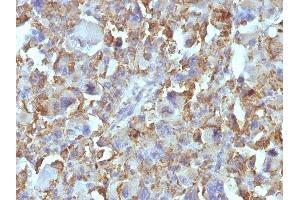 Formalin-fixed, paraffin-embedded human Histiocytoma stained with Macrophage Monoclonal Antibody (D11). (Macrophage / Histiocytoma Marker Antikörper)