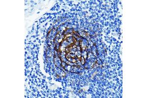 Immunohistochemistry of paraffin-embedded human lung cancer using p75NTR/NGFR Rabbit mAb (ABIN7268850) at dilution of 1:100 (40x lens). (NGFR Antikörper)