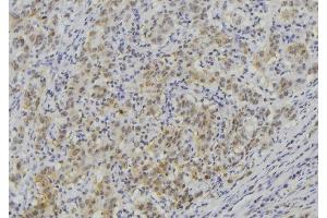 ABIN6273513 at 1/100 staining Human lung cancer tissue by IHC-P. (LAMC3 Antikörper  (Internal Region))