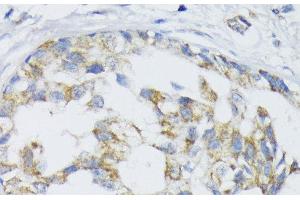 Immunohistochemistry of paraffin-embedded Human mammary cancer using SLC30A1 Polyclonal Antibody at dilution of 1:100 (40x lens). (SLC30A1 Antikörper)