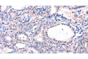 Immunohistochemistry of paraffin-embedded Human thyroid cancer tissue using DUSP12 Polyclonal Antibody at dilution 1:77 (DUSP12 Antikörper)