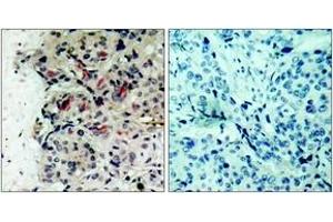 Immunohistochemistry analysis of paraffin-embedded human breast carcinoma tissue, using JAK1 (Ab-1022) Antibody. (JAK1 Antikörper  (AA 988-1037))