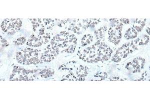 Immunohistochemistry of paraffin-embedded Human esophagus cancer tissue using BRD3 Polyclonal Antibody at dilution of 1:60(x200) (BRD3 Antikörper)