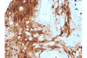 Formalin-fixed, paraffin-embedded human skin carcinoma stained with Calprotectin Mouse Monoclonal Antibody (S100A9/1075).