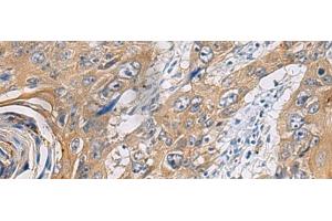 Immunohistochemistry of paraffin-embedded Human esophagus cancer tissue using PA2G4 Polyclonal Antibody at dilution of 1:60(x200) (PA2G4 Antikörper)