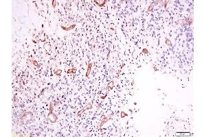 Formalin-fixed and paraffin embedded human neurological glioblastoma labeled with Anti-OPRD1 (Ser363) Polyclonal Antibody, Unconjugated  at 1:200 followed by conjugation to the secondary antibody and DAB staining. (OPRD1 Antikörper  (pSer363))
