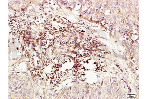 Formalin-fixed and paraffin embedded human lung carcinoma labeled with Anti-CD184/CXCR4 Polyclonal Antibody (ABIN730888), Unconjugated at 1:200, followed by conjugation to the secondary antibody and DAB staining (CXCR4 Antikörper  (AA 201-294))