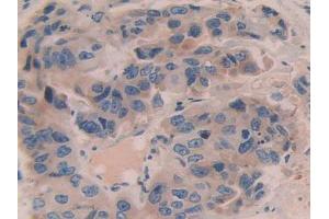 IHC-P analysis of Human Breast Cancer Tissue, with DAB staining. (Contactin 4 Antikörper  (AA 731-980))
