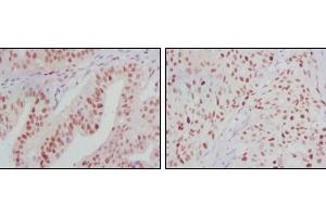 Immunohistochemical analysis of paraffin-embedded human ovarian cancer (left) and breast cancer (right) tissues using ATP2C1 mouse mAb with DAB staining. (ATP2C1 Antikörper)