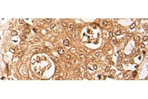 Immunohistochemistry of paraffin-embedded Human prost ate cancer tissue using ZPR1 Polyclonal Antibody at dilution of 1:40(x200) (ZNF259 Antikörper)
