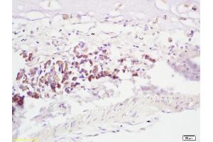 Formalin-fixed and paraffin embedded human lung carcinoma labeled with Anti-RNF43 Polyclonal Antibody, Unconjugated (ABIN721600) at 1:200, followed by conjugation to the secondary antibody and DAB staining (RNF43 Antikörper  (AA 41-140))