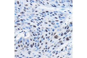 Immunohistochemistry of paraffin-embedded human esophageal cancer using NUDT21 Rabbit pAb (ABIN1681134, ABIN3018973, ABIN3018974 and ABIN6220652) at dilution of 1:100 (40x lens). (NUDT21 Antikörper  (AA 1-227))