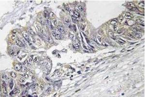 Immunohistochemistry (IHC) analyzes of p-JNK1/2/3 antibody in paraffin-embedded human colon carcinoma tissue. (JNK Antikörper  (pThr183))