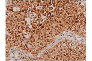 ABIN6267363 at 1/200 staining Human lung cancer tissue sections by IHC-P. (MAPT Antikörper  (pSer262))