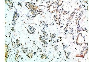 Immunohistochemical analysis of paraffin-embedded human-stomach-cancer, antibody was diluted at 1:200 (FCGR1A Antikörper  (AA 230-280))