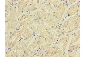 Immunohistochemistry of paraffin-embedded human gastric cancer using ABIN7147210 at dilution of 1:100 (CDC42EP2 Antikörper  (AA 9-210))