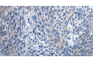 Immunohistochemistry of paraffin-embedded Human cervical cancer using IL2RB Polyclonal Antibody at dilution of 1:30 (IL2 Receptor beta Antikörper)