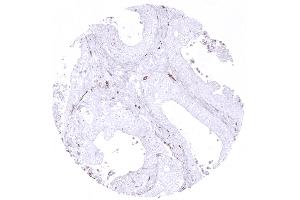 Adenocarcinoma of the colon with low content of CD163 positive macrophages (CD163 Antikörper  (AA 43-196))