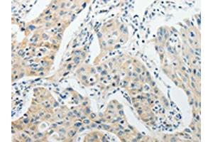 The image on the left is immunohistochemistry of paraffin-embedded Human lung cancer tissue using ABIN7189714(AGBL1 Antibody) at dilution 1/15, on the right is treated with synthetic peptide. (AGBL1 Antikörper)