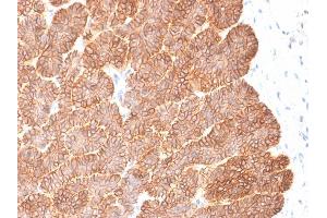 Formalin-fixed, paraffin-embedded human Basal Cell Carcinoma stained with EpCAM Rabbit Recombinant Monoclonal Antibody (EGP40/2041R). (Rekombinanter EpCAM Antikörper  (Extracellular Domain))