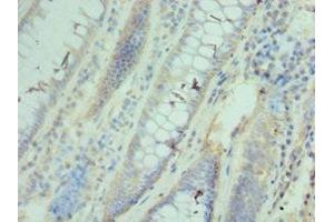 Immunohistochemistry of paraffin-embedded human colon cancer using ABIN7171427 at dilution of 1:100 (CCT3 Antikörper  (AA 1-300))