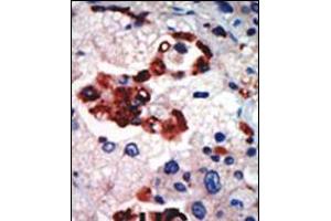 Formalin-fixed and paraffin-embedded human cancer tissue reacted with the primary antibody, which was peroxidase-conjugated to the secondary antibody, followed by AEC staining. (PKC iota Antikörper  (N-Term))