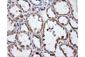 Immunohistochemical staining of paraffin-embedded Adenocarcinoma of ovary tissue using anti-ANXA1 mouse monoclonal antibody. (Annexin a1 Antikörper)