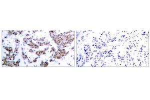 Immunohistochemical analysis of paraffin-embedded human breast carcinoma tissue, using MEF2A (phospho-Thr312) antibody (E011039). (MEF2A Antikörper  (pThr312))