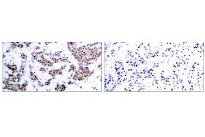 Immunohistochemical analysis of paraffin-embedded human breast carcinoma tissue, using MEF2A (phospho-Thr312) antibody (E011039). (MEF2A Antikörper  (pThr312))
