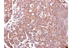 IHC-P Image Mucin 4 antibody detects Mucin 4 protein at cytosol on human breast carcinoma by immunohistochemical analysis. (MUC4 Antikörper)