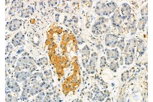 ABIN6260353 and ABIN6277507 at 1/100 staining Human pancreatic cancer and adjacent nomal tissues by IHC-P. (C10orf2 Antikörper  (C-Term))