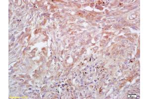 Formalin-fixed and paraffin embedded human lung carcinoma labeled with Rabbit Anti Trk A/B/C Polyclonal Antibody, Unconjugated (ABIN726095) at 1:200 followed by conjugation to the secondary antibody and DAB staining (TrkA, B, C (AA 668-750) Antikörper)