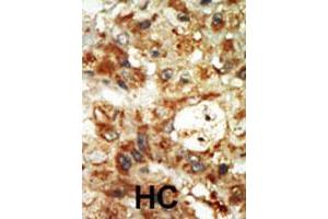 Formalin-fixed and paraffin-embedded human hepatocellular carcinoma tissue reacted with MAPK12 polyclonal antibody  , which was peroxidase-conjugated to the secondary antibody, followed by AEC staining. (MAPK12 Antikörper  (Internal Region))