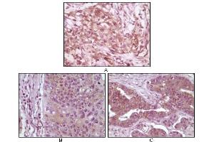 Immunohistochemical analysis of paraffin-embedded human pancreas carcinoma (A), esophagus carcinoma tissue (B) and ovary tumor tissue (C), showing cytoplasmic and membrane localization using 4E-BP1 antibody with DAB staining. (eIF4EBP1 Antikörper)