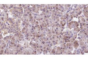 ABIN6273233 at 1/100 staining Human pancreas cancer tissue by IHC-P. (DYNC2LI1 Antikörper  (Internal Region))