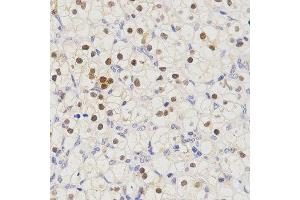 Immunohistochemistry of paraffin-embedded human kidney cancer tissue using SCTR antibody at dilution of 1:200 (x400 lens) (SCTR Antikörper)