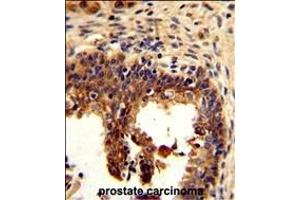 Formalin-fixed and paraffin-embedded human prostate carcinoma reacted with KRT4 Antibody (C-term), which was peroxidase-conjugated to the secondary antibody, followed by DAB staining. (KRT4 Antikörper  (C-Term))