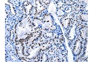 The image on the left is immunohistochemistry of paraffin-embedded Human thyroid cancer tissue using ABIN7191961(POU2AF1 Antibody) at dilution 1/15, on the right is treated with synthetic peptide. (POU2AF1 Antikörper)
