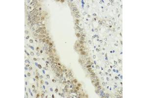 Immunohistochemistry of paraffin-embedded human uterine cancer using LDB1 antibody (ABIN7268255) at dilution of 1:200 (40x lens). (LIM Domain Binding 1 Protein Antikörper  (AA 1-50))