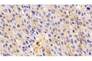 Detection of ORM2 in Human Liver cancer Tissue using Polyclonal Antibody to Orosomucoid 2 (ORM2)