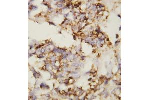 Anti-N Cadherin antibody, IHC(P) IHC(P): Human Ovary Cancer Tissue