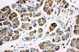 Anti-Kallikrein 1 antibody, IHC(P) IHC(P): Human Pancreatic Cancer Tissue (Kallikrein 1 Antikörper  (Middle Region))