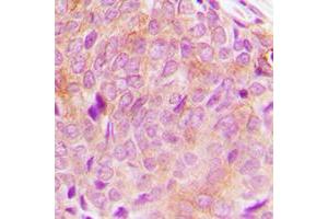 Immunohistochemical analysis of PLC gamma 2 staining in human breast cancer formalin fixed paraffin embedded tissue section. (Phospholipase C gamma 2 Antikörper  (C-Term))
