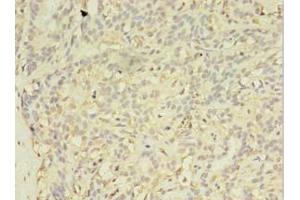 Immunohistochemistry of paraffin-embedded human breast cancer using ABIN7152293 at dilution of 1:100 (EXOSC5 Antikörper  (AA 1-235))