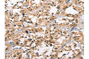 The image on the left is immunohistochemistry of paraffin-embedded Human thyroid cancer tissue using ABIN7190849(GPR182 Antibody) at dilution 1/30, on the right is treated with synthetic peptide. (G Protein-Coupled Receptor 182 Antikörper)