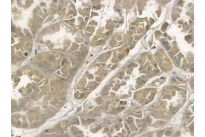 ABIN6258306 and ABIN6274290 at 1/100 staining human renal cell carcinoma by IHC-P. (PTTG1 Antikörper  (C-Term))
