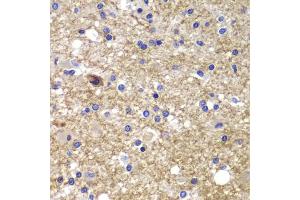 Immunohistochemistry of paraffin-embedded human brain cancer using CDK6 antibody (ABIN1871736) at dilution of 1:100 (40x lens). (CDK6 Antikörper)