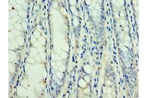 Immunohistochemistry of paraffin-embedded human colon cancer using ABIN7169764 at dilution of 1:100